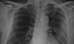 Radiografía de tórax y tomografía computarizada de un paciente brasileño con neumonía por COVID-19 [Originalmente publicado en Rev. Soc. Bras. Med. Trop. vol. 53]