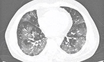 Informe estructurado de tomografía computarizada de tórax para la pandemia de COVID-19 [Originalmente publicado en Einstein, vol. 18]