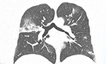 Presentación tomográfica de infección pulmonar en COVID-19: experiencia brasileña inicial [Originalmente publicado en J. bras. pneumol., vol. 46 no. 2]