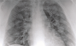 O sinal do halo como apresentação tomográfica pulmonar na COVID-19 [Originalmente publicado na Einsten, vol. 18]