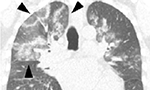 Pneumonia por COVID-19 e o sinal do halo invertido [Originalmente publicado no J. bras. pneumol., vol. 46 no. 2]